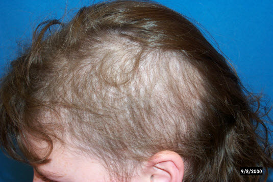 Trichotillomanie. Die Bereiche, aus denen die Haare ausgerissen werden, sind fast nie völlig haarlos, es bleiben kurze und abgebrochene Haarsträhnen unterschiedlicher Länge.