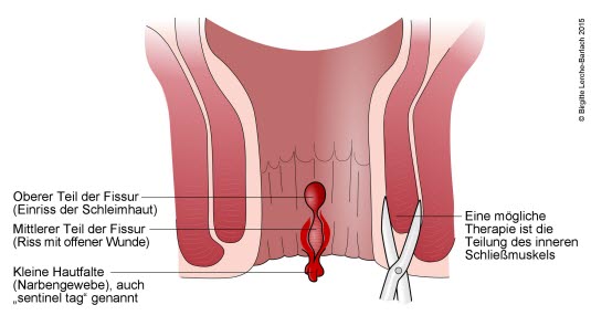 Analfissur