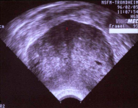 Sertoli-Leydig-Zell-Tumor, Ultraschall