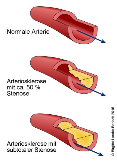 Entwicklung einer Arteriosklerose