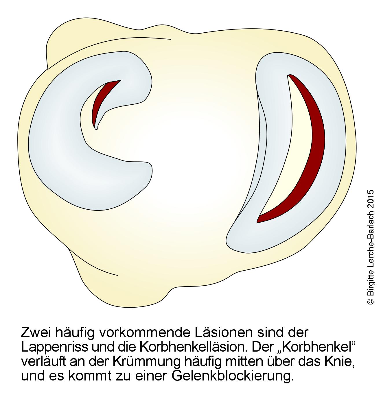 Meniskusschaden: Lappenriss und Korbhenkelläsion