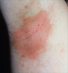 Die Psoriasis inversa führt zu beugeseitigen Hautveränderungen und affiziert vor allem intertriginöse Bereiche wie die Glutealfalte, die Axillae und die Glans penis. In diesen Bereichen tritt häufig keine Schuppung auf.