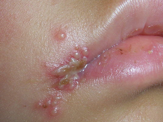 Herpes labialis. Die intra- oder periorale Primärinfektion erfolgt meist bei Kindern im Alter von ein bis fünf Jahren. Spätere Ausbrüche manifestieren sich als rezidivierender Herpes labialis mit „Fieberbläschen“.