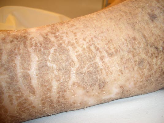 Ichthyosis. Die erworbene Form ist nicht vererbt, sondern das Symptom einer Systemerkrankung. Sie kann bereits vor oder erst nach Ausbruch der zugrunde liegenden Erkrankung auftreten.