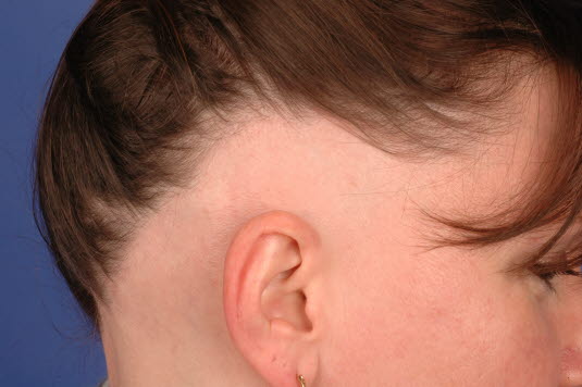 Alopecia areata