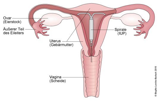 Intrauterin platzierte Spirale (Intrauterinpessar, IUP)