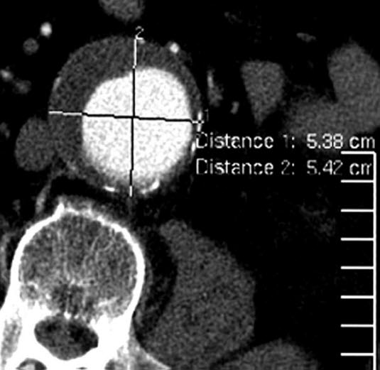 Aortenaneurysma, Querschnitt, CT