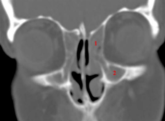 Verstopfter Sinus maxillaris und Sinus frontalis, Sinusitis, CT