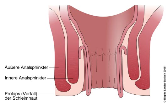 Senkung des Enddarms