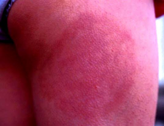 Erythema migrans