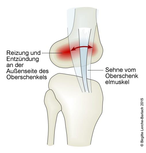 Läuferknie, Tendinopathie des Tractus iliotibialis