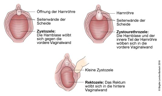 Zysto-, Zystourethro-, Rektozele