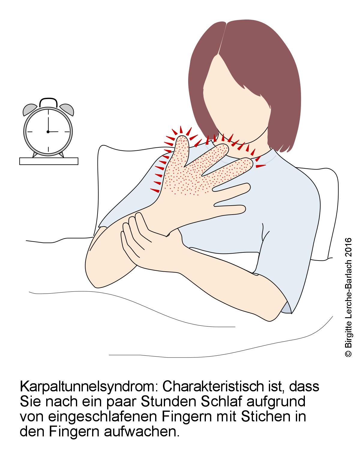 Karpaltunnelsyndrom, Gefuehllosigkeit in den Fingern.jpg