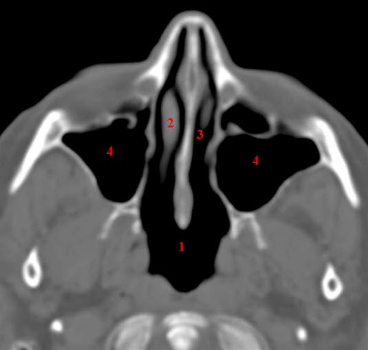 Sinus maxillaris, axial, CT