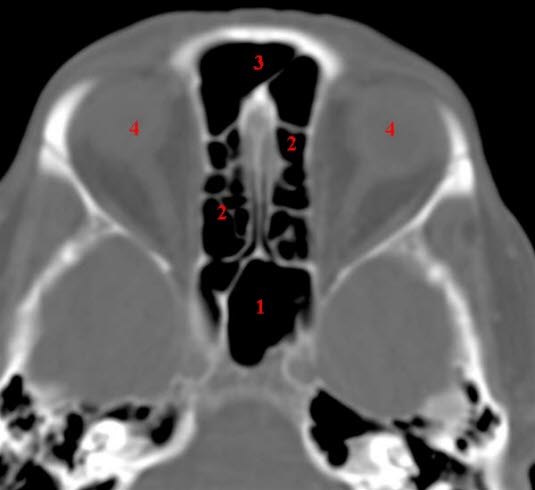 Sinus ethmoidalis und sphenoidalis, axial, CT 