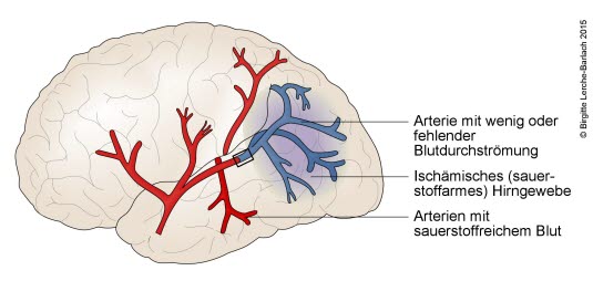 Hirninfarkt (Schlaganfall durch Gefäßverschluss)