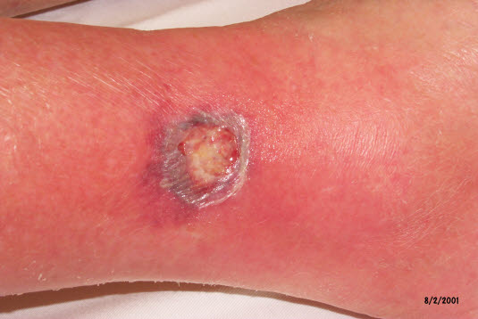 Pyoderma gangraenosum (typischer unterminierter Wundrand)