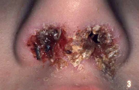 Impetigo contagiosa