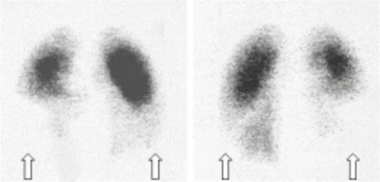 Lungenembolie - Perfusionsszintigrafie