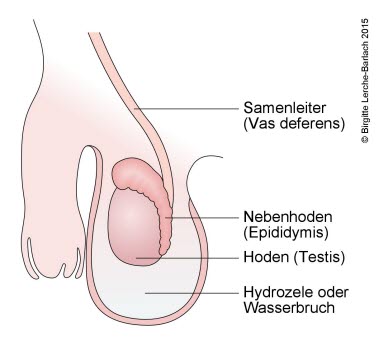 435-hydrozele-wasserbruch.jpg