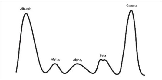 Serumproteinelektrophorese, Myelom