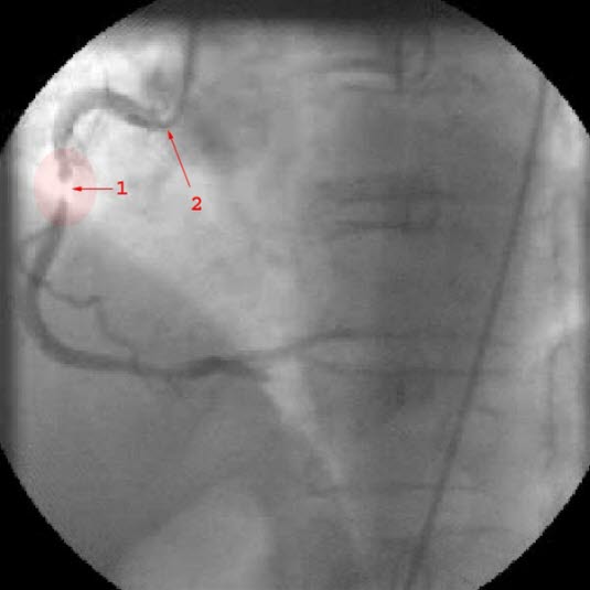 Koronarangiografie: Darstellung einer hochgradige Stenosen (1) in der rechten Koronararterie (2 = Katheter).