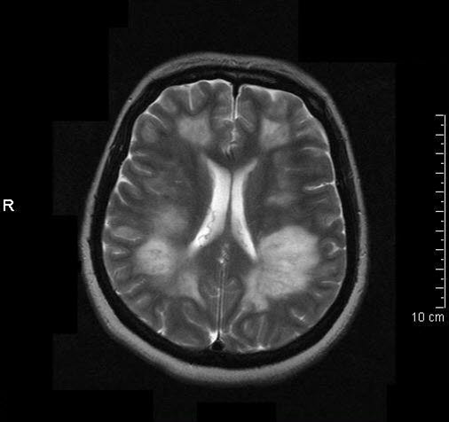 Akute disseminierte Enzephalitis