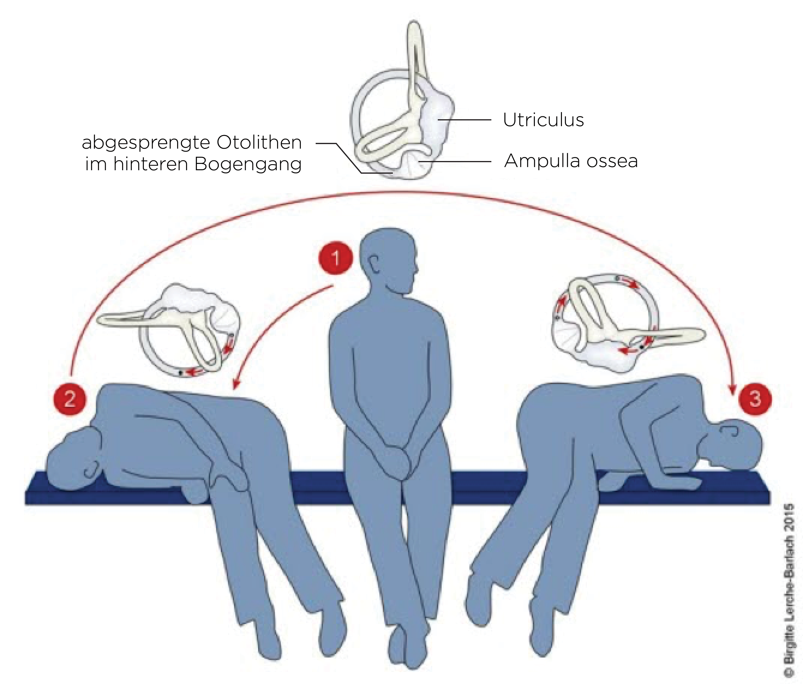 BPPV-Heimübung_Lagerungsschwindel_34733.png