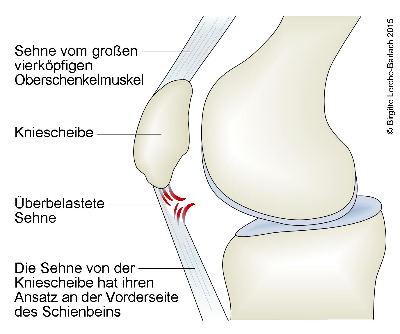 Springerknie (Jumper's knee).jpg