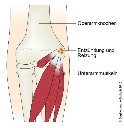 Mediale Epikondylitis