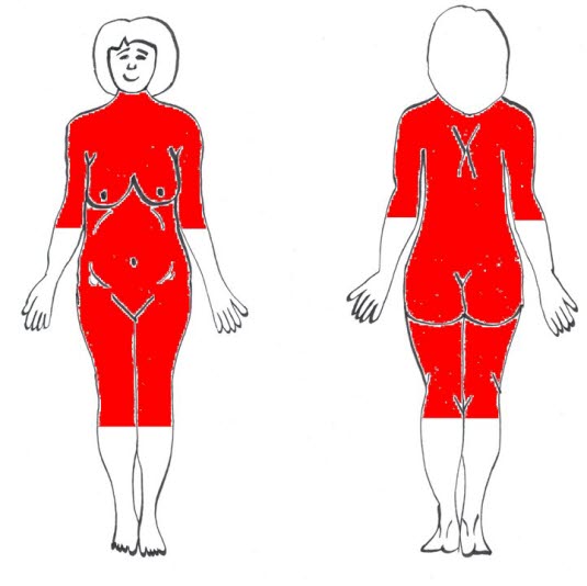 Klassisches Verbreitungsmuster des Pemphigoid gestationis