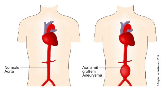 Bauchaortenaneurysma