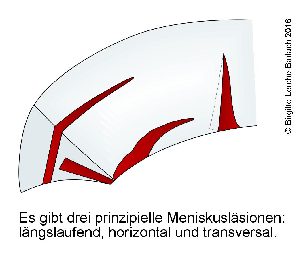 Meniskusläsionen, Übersicht