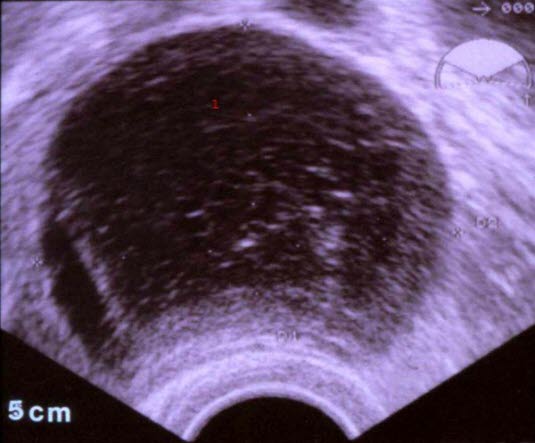 Komplexe Zyste: Hämorrhagische Zyste, Ultraschall