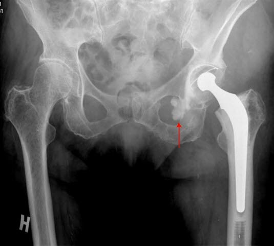 Totale Hüftendoprothese, Röntgen
