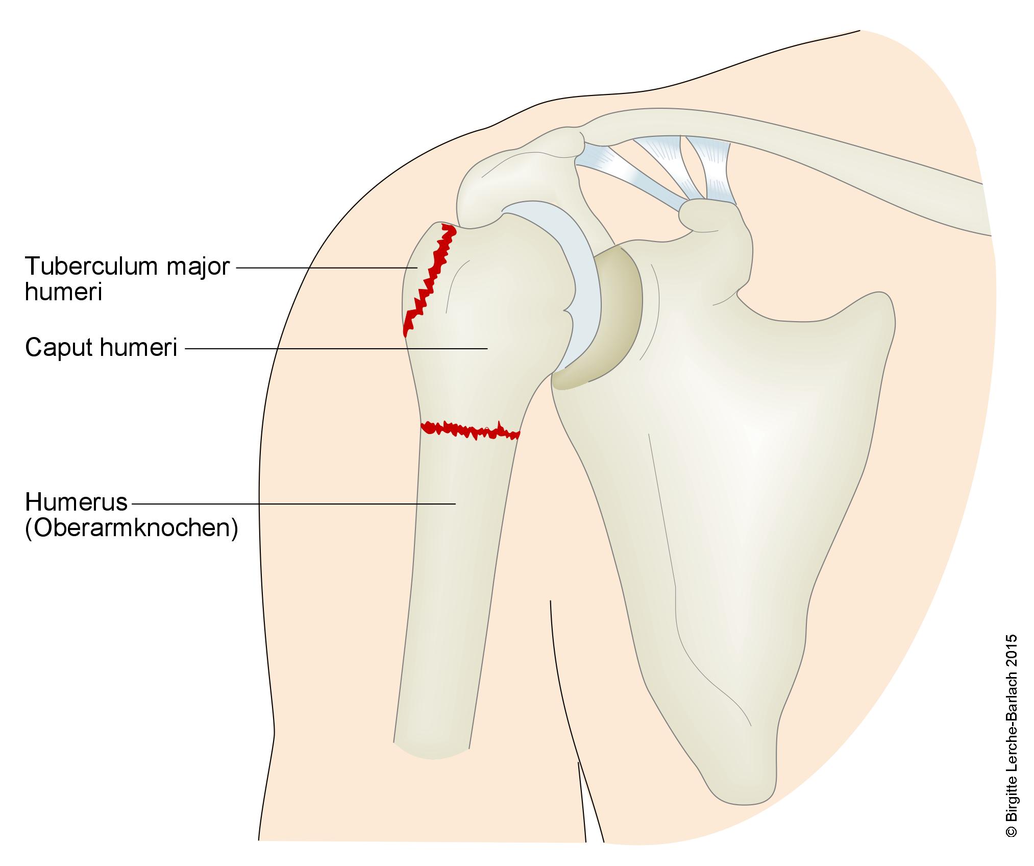 Humerus, Brucharten im oberen Teil