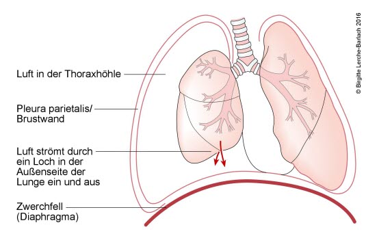 Spannungspneumothorax