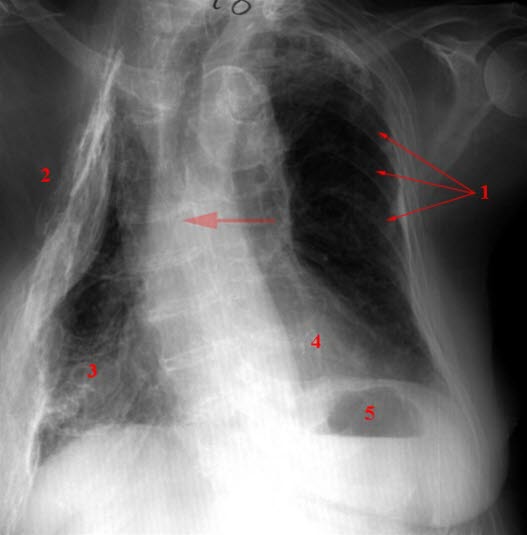 Z. n. Tuberkulose und Thorakoplastik