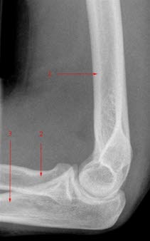 Normales Ellenbogengelenk, von der Seite: 1. Humerus (Oberarmknochen), 2. Radius (Speiche), 3. Ulna (Elle)