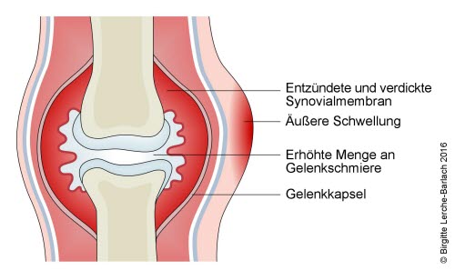 Akute Gelenkentzündung