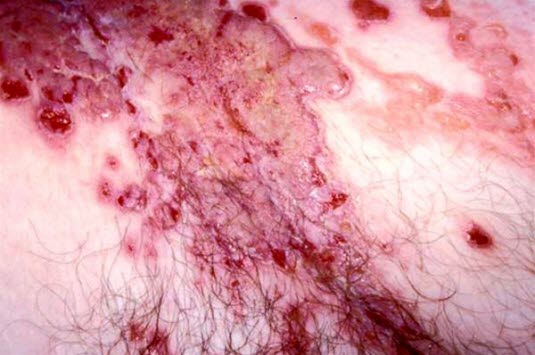 Pemphigus vulgaris. Schlaffe Blasen in verschiedenen Größen auf normaler Haut, diese platzen einfach und gehen zu erythematöser, erodierter Haut über.