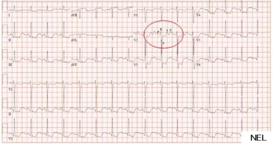 EKG-Veränderungen bei Hypokaliämie