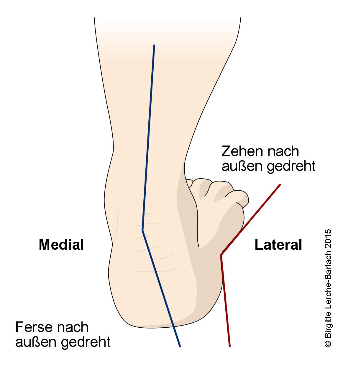 Plattfuß, Ferse von hinten