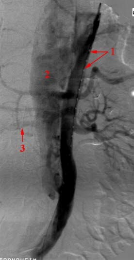 Aortendissektion, Angiografie