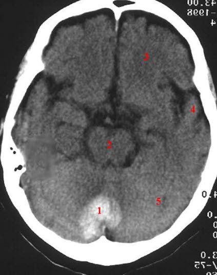 Hämatom im Zerebellum, CT