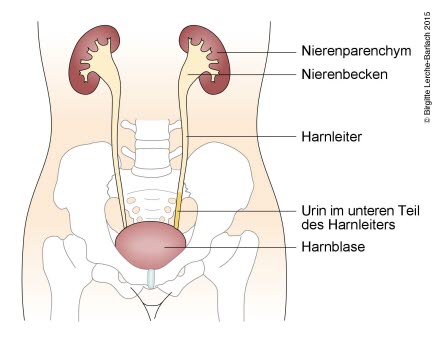 Urinreflux Grad 1