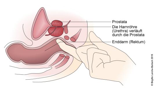 Digitale rektale Untersuchung der Prostata