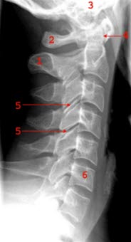 Normale Seitenansicht der Halswirbelsäule: 1. Processus spinosus, 2. Atlas, 3. Schädelbasis, 4. Dens axis, 5. Intervertebralgelenk (Facettengelenk), 6. Wirbelkörper C6