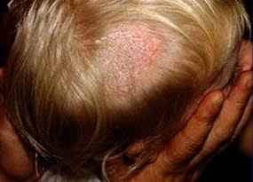 Alopezie infolge von Tinea capitis. Pustulöser Typ.