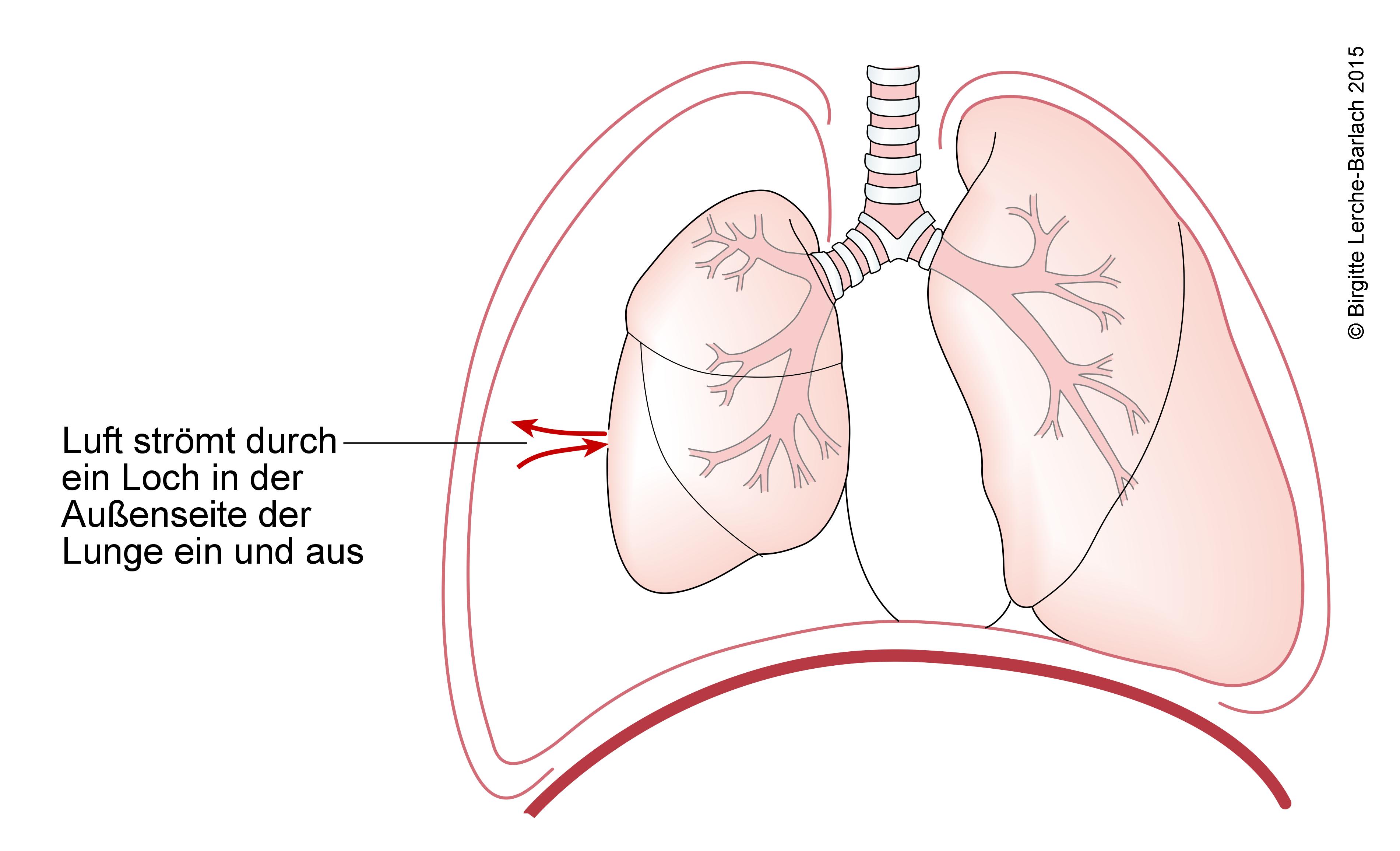 Pneumothorax, vollständig